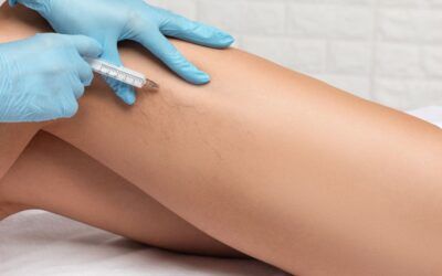 ¿Por qué salen las arañas vasculares y las varices leves, y cómo eliminarlas?