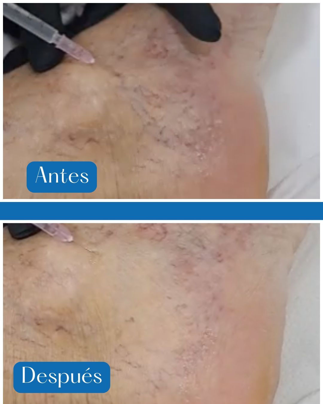 Antes-Después de tratamiento de varices