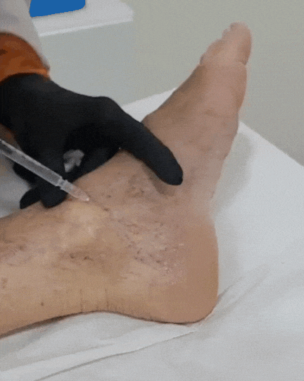 Tratamiento de Estimulador de colágeno